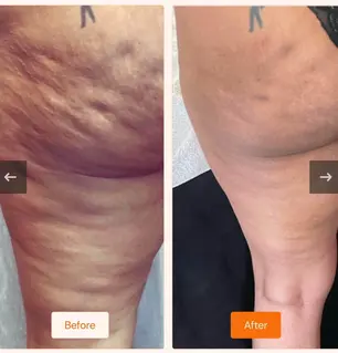 Leg cellulite treatment