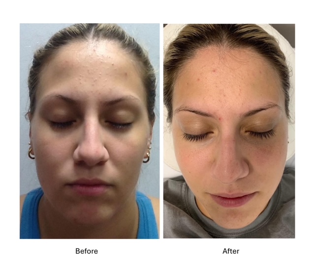 Cryo Facials - before and after