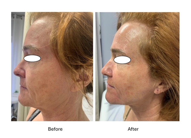 Cryo Facials - before and after