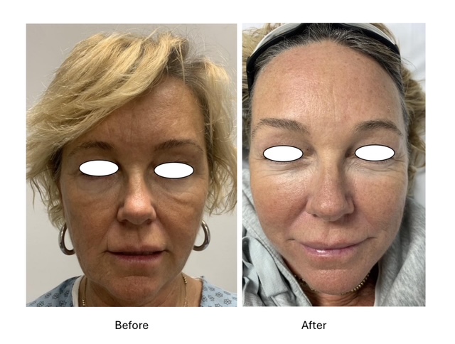 Cryo Facials - before and after