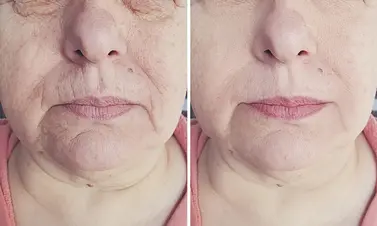 Cosmetic treatment session