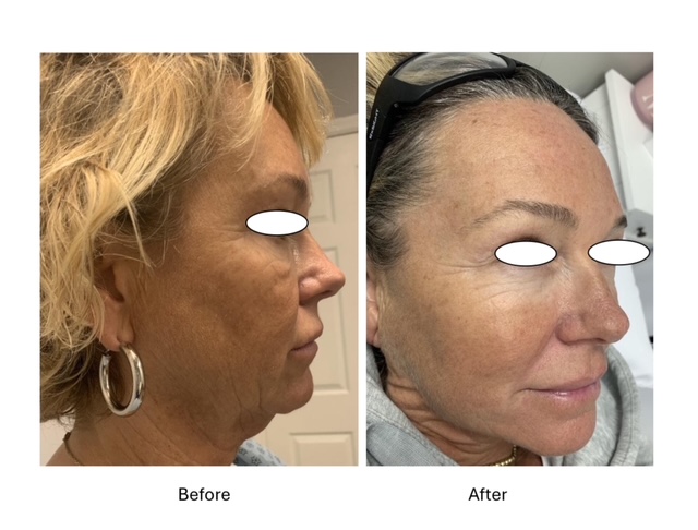 Cryo Facials - before and after