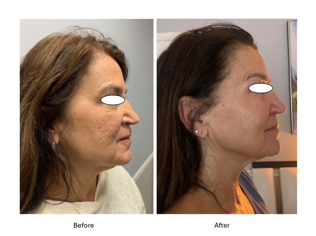 Cryo Facials - before and after