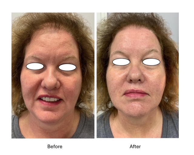 Cryo Facials - before and after