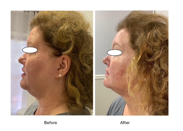 Cryo Facials - before and after