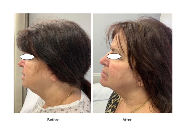 Cryo Facials - before and after