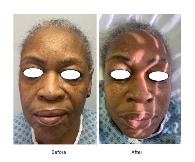 Cryo Facials - before and after