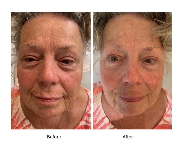 Cryo Facials - before and after