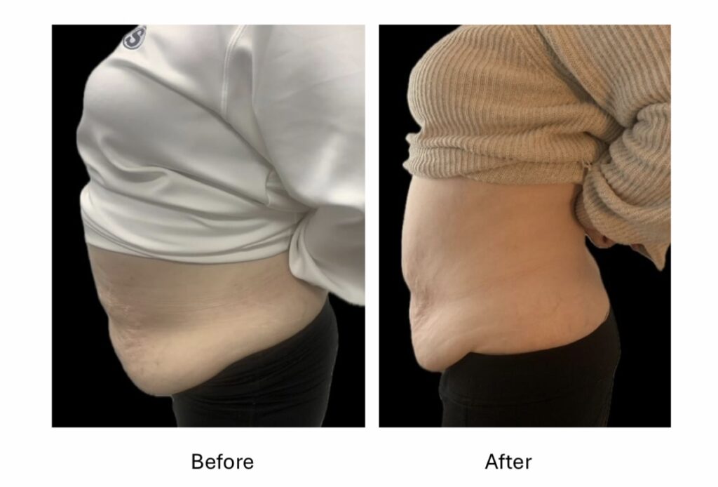 Belly Fat Reduction