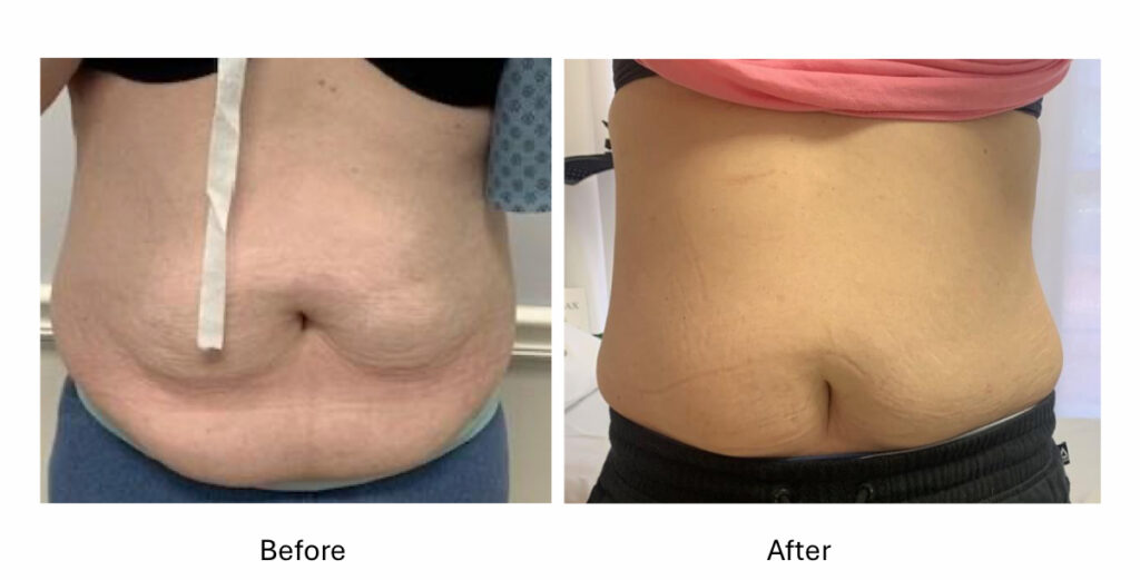 Belly Fat Reduction