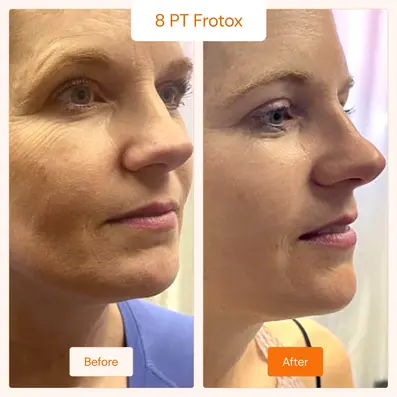 Skin rejuvenation before after