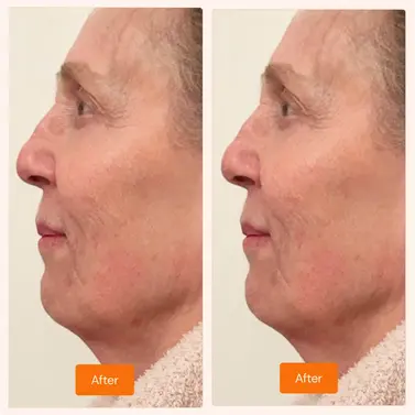 Before and after skin treatment