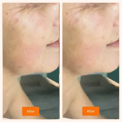 Skin improvement after treatment